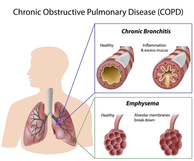 different types of copd and their impact