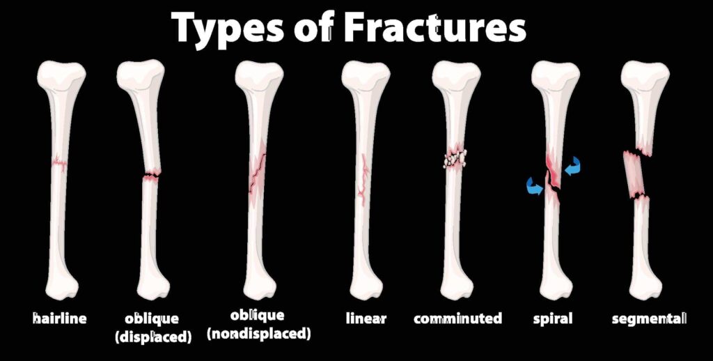 different types of fractures examples explained
