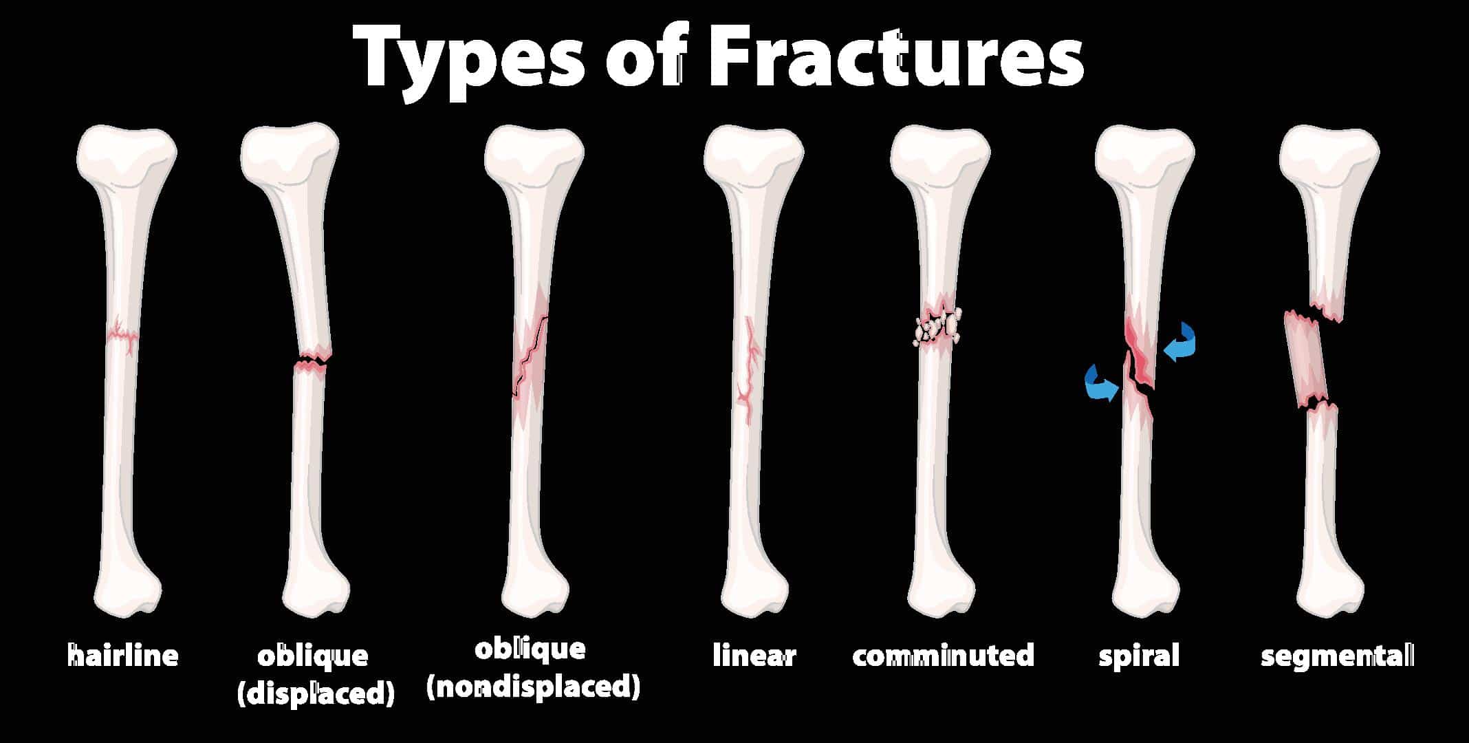 different types of fractures examples explained