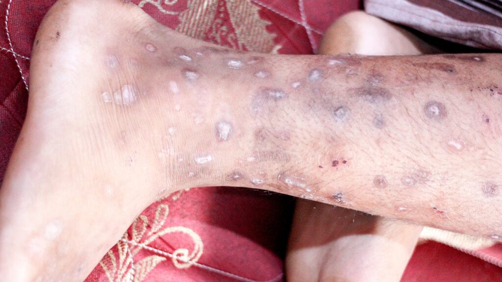 examples of localized infections you should know about