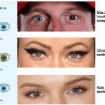 examples of sectoral heterochromia in people
