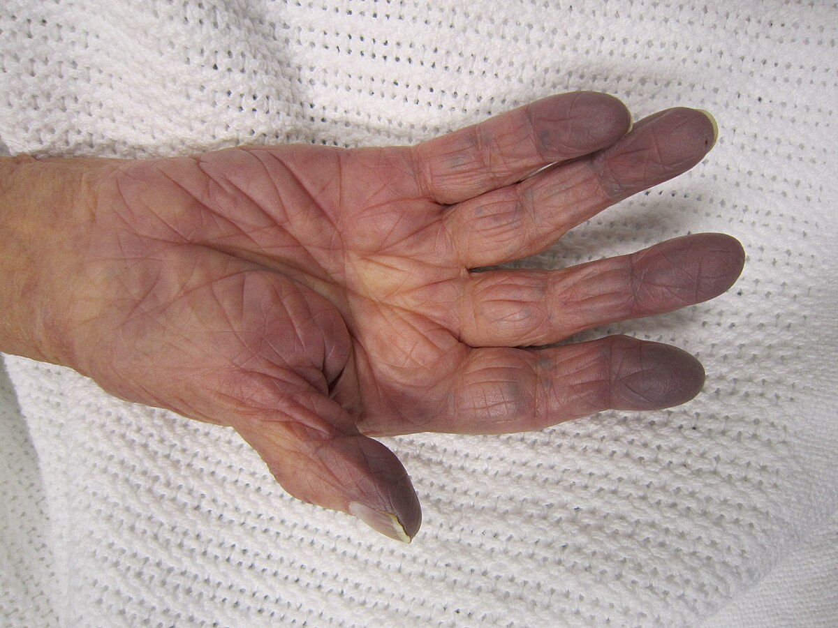 examples of when you would typically observe cyanosis
