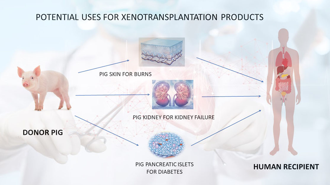 examples of xenotransplantation in modern medicine
