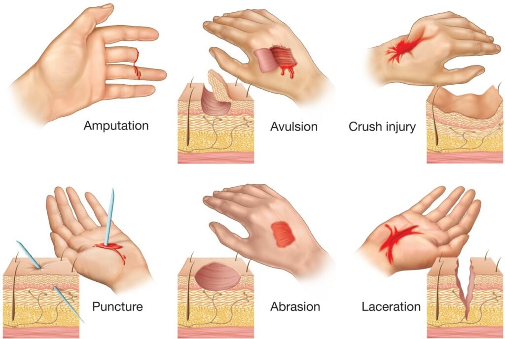 open wound types and their treatment examples