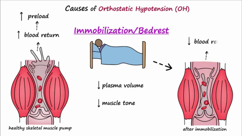 orthostatic hypotension symptoms explained