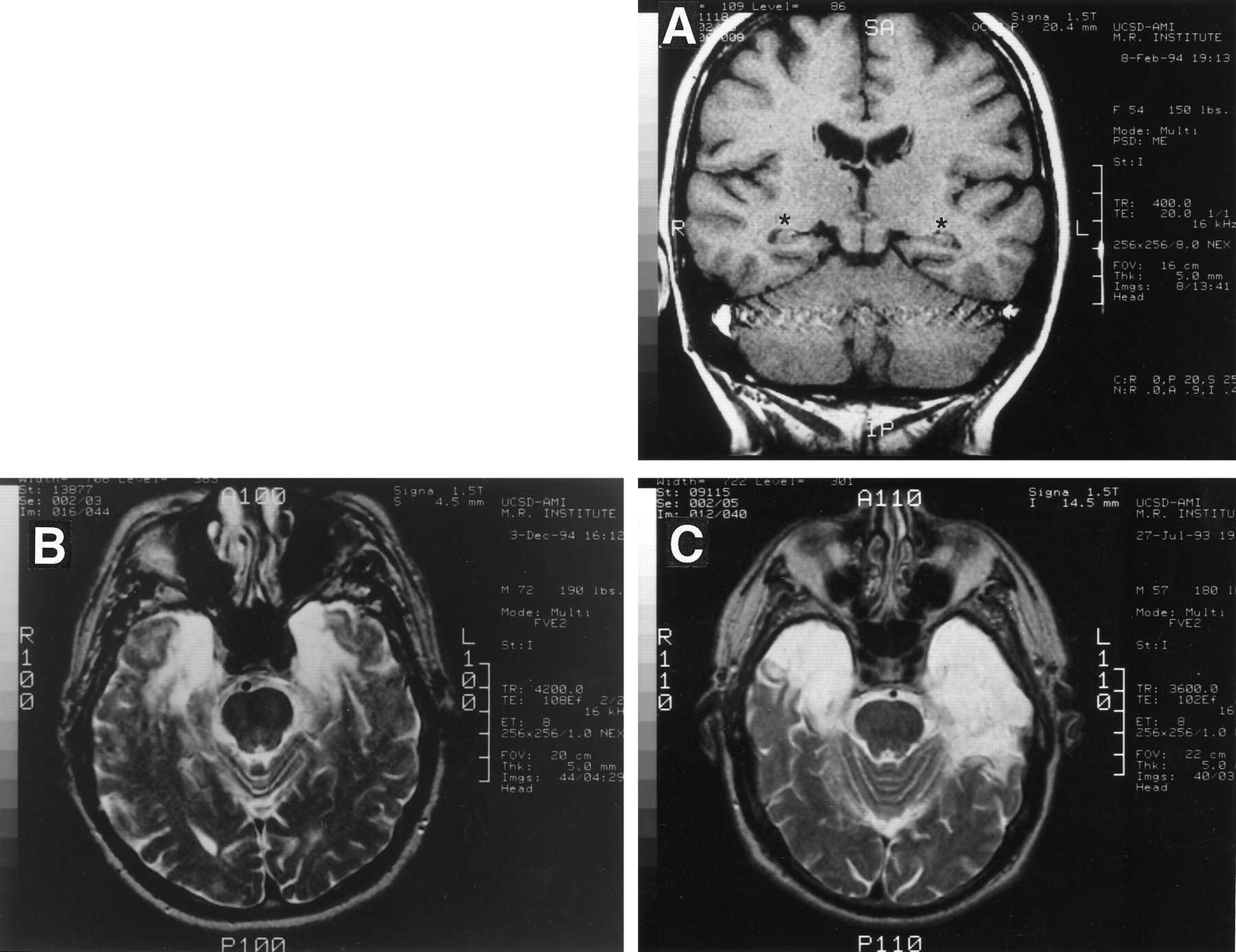 retrograde amnesia in ap psychology key examples