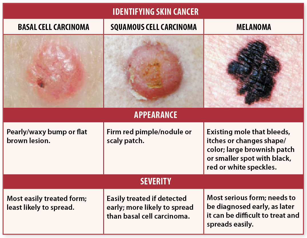 Skin Cancer Pictures Recognize Signs For Early Detection Skin Cancer Pictures Recognize Signs For Early Detection