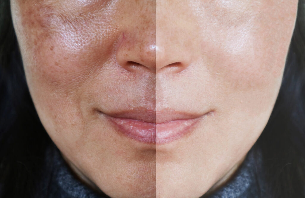 solutions for uneven skin tone you should try