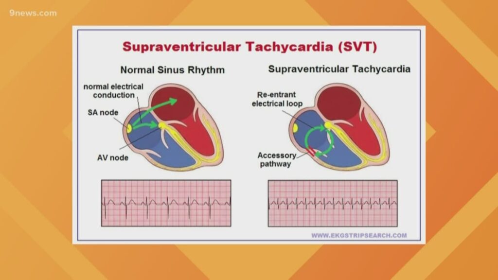 svt common types and symptoms explained