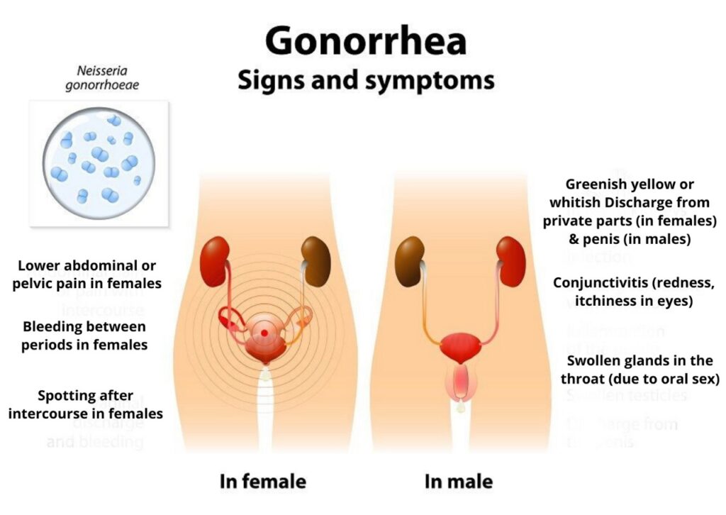 symptoms of gonorrhea and chlamydia in women