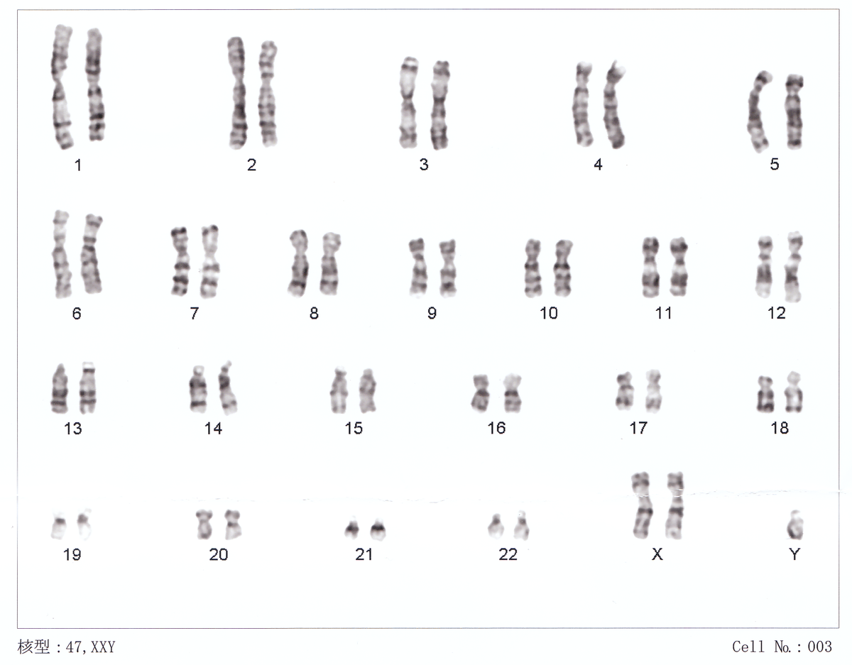 turner and klinefelter syndromes chromosome number changes