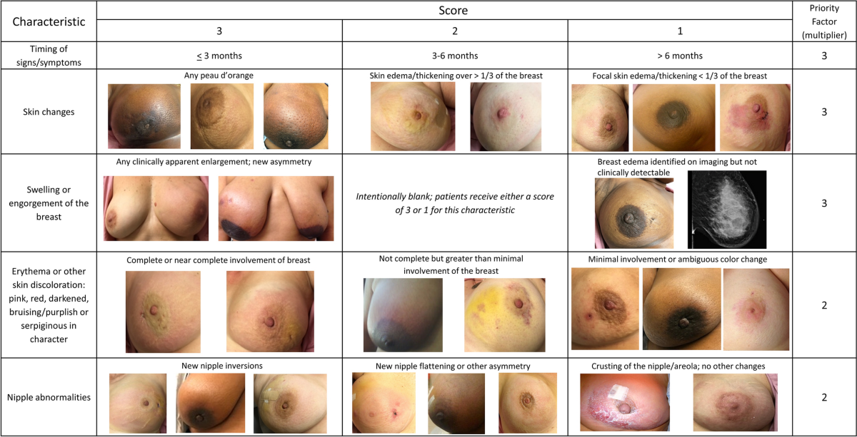 types of breast cancer key examples