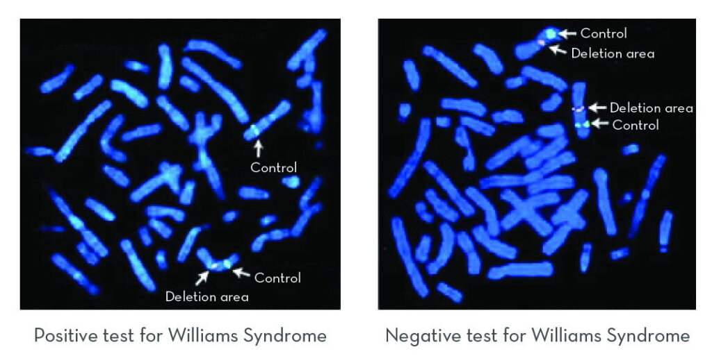 williams syndrome cri du chat examples of chromosome deletions